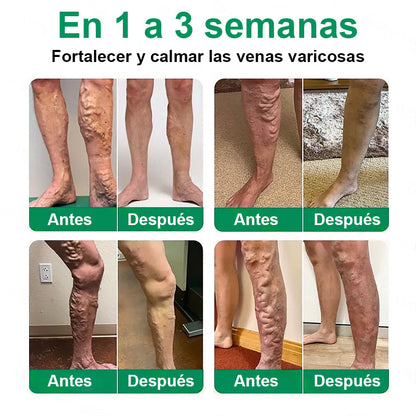 🇵🇦👨‍⚕️✅ Healrize® VeinTarget parche de microagujas ⚡ Alivio inmediato, resultados duraderos