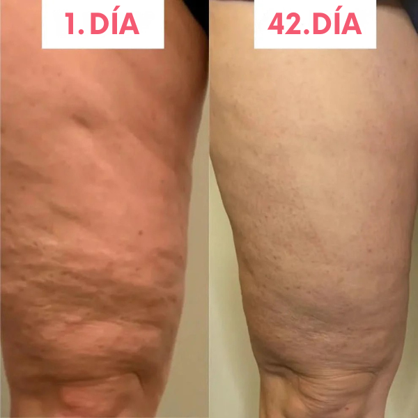 Reduce celulitis en semanas | Masajeador-Anticelulitis™
