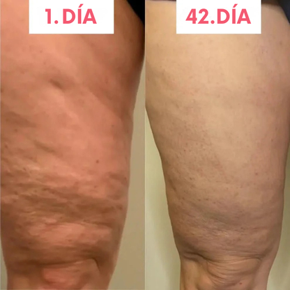Reduce celulitis en semanas | Masajeador-Anticelulitis™