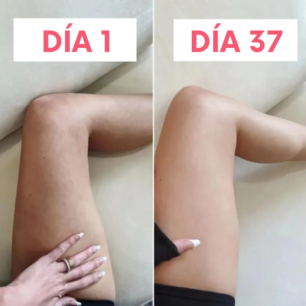 Masajeador anticelulitis